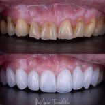 Vorher-nachher-Ergebnis von Porzellanveneers bei About Tooth Dental Clinic, Lächeln-Transformation