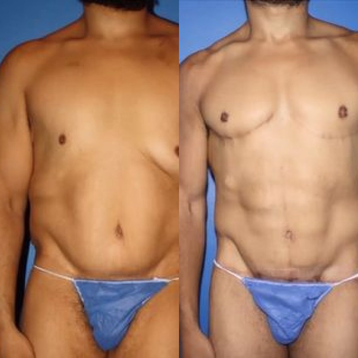 Resultados de lipofilling antes y después en Cairo Plastic Clinic, contorno abdominal masculino mejorado