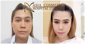 Résultats avant/après de féminisation faciale à Asia Cosmetic Hospital, féminité renforcée