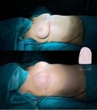 Before and after breast lift with round implants at Dr. MED – visible contour improvement result