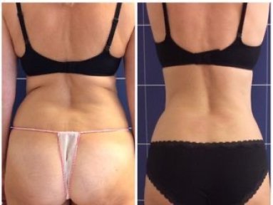 Vorher-nachher-Liposuktionsergebnis bei LaCLINIQUE of Switzerland, verbesserte Taillenkontur