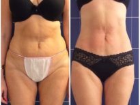 Liposuktion Vorher-Nachher-Ergebnis bei LaCLINIQUE of Switzerland, verbesserte Bauchkontur