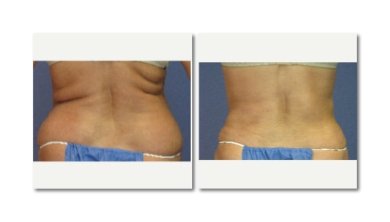 Vorher-nachher-Liposuktionsergebnisse bei LaCLINIQUE of Switzerland, sichtbare Taillenkontur