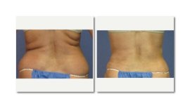 Vorher-nachher-Liposuktionsergebnisse bei LaCLINIQUE of Switzerland, sichtbare Taillenkontur