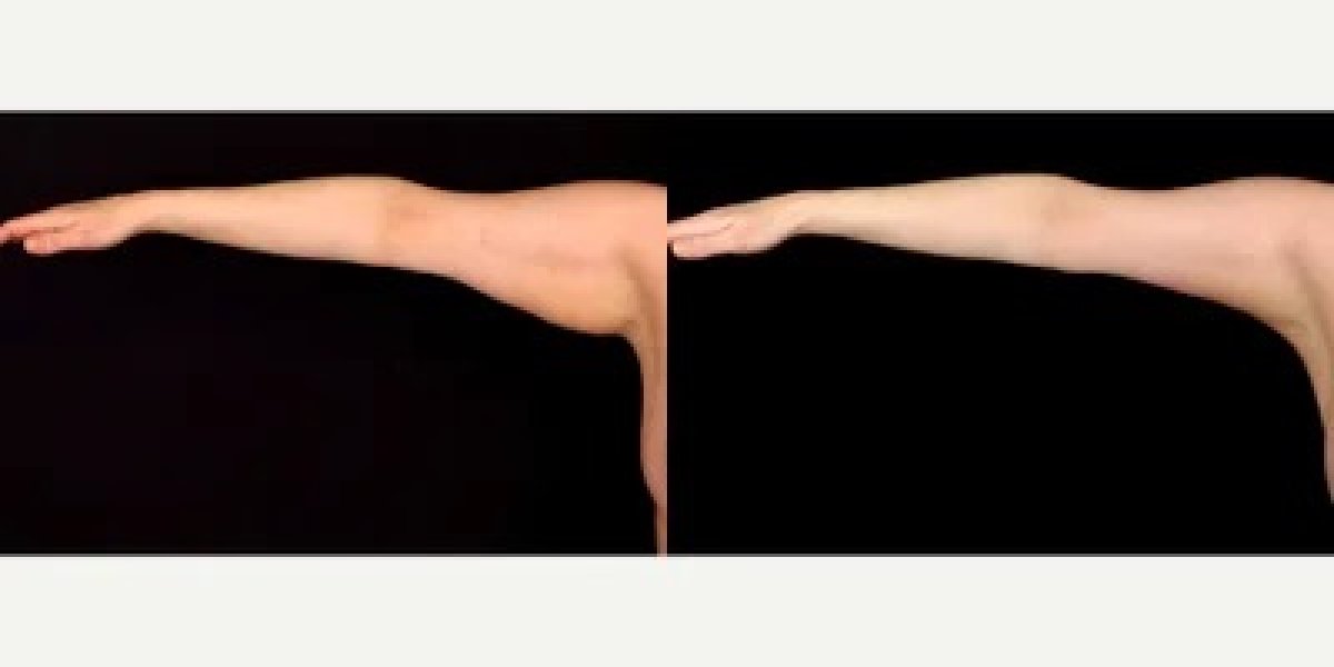 Resultados antes y después de lifting de brazos en LaCLINIQUE of Switzerland, mejor contorno