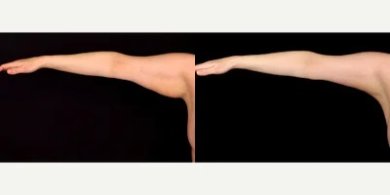 Vorher-nachher-Ergebnis Armlifting bei LaCLINIQUE of Switzerland, verbesserte Kontur