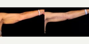 Vorher-nachher-Ergebnisse der Armlifting bei LaCLINIQUE of Switzerland, verbesserte Kontur
