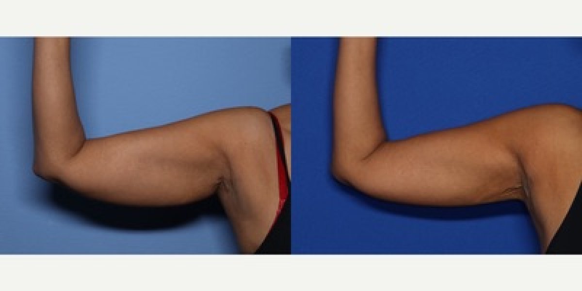 Resultados antes y después de lifting de brazos en LaCLINIQUE of Switzerland, mejor contorno