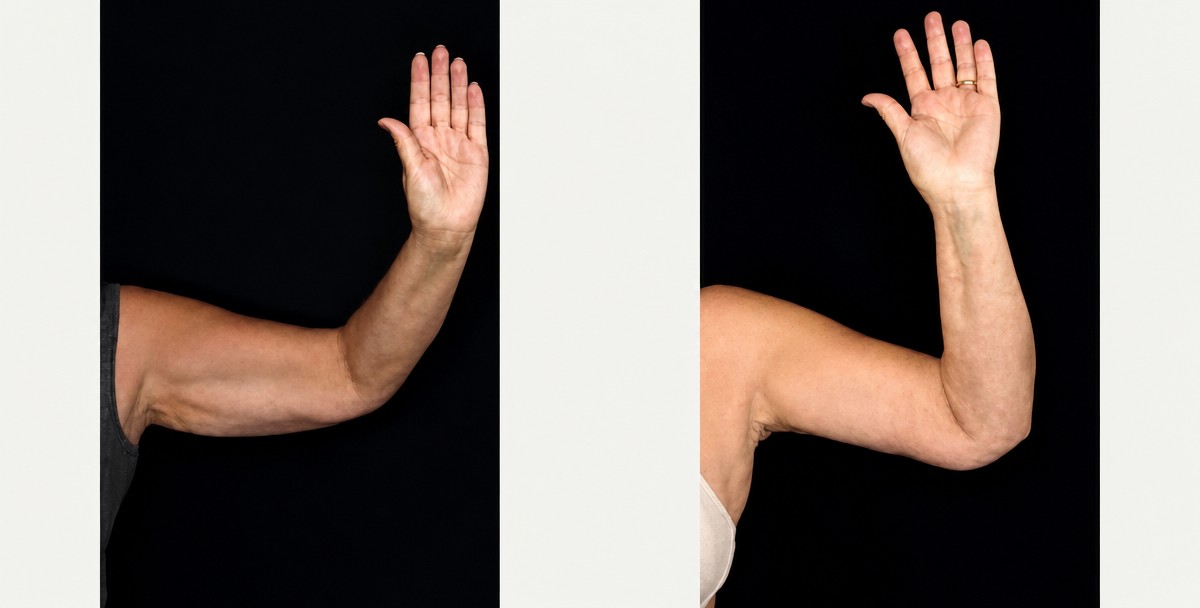 Resultados antes y después de lifting de brazos en LaCLINIQUE of Switzerland, mejor contorno