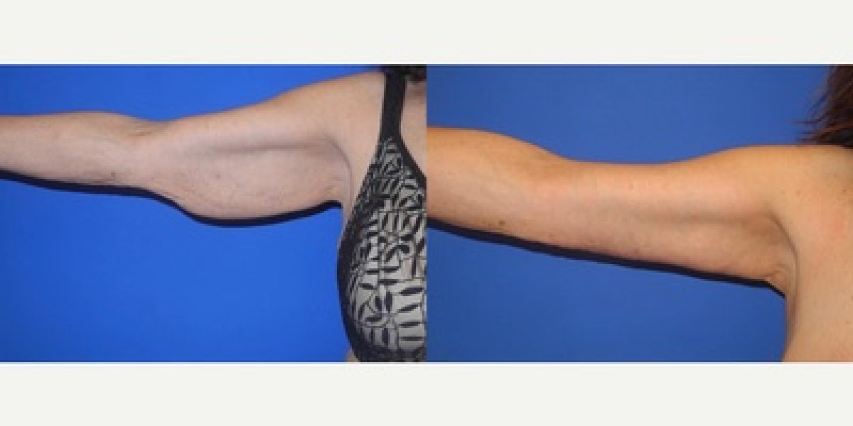 Resultados antes y después de lifting de brazos en LaCLINIQUE of Switzerland, mejor contorno