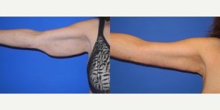 Vorher-nachher-Ergebnis Armlifting bei LaCLINIQUE of Switzerland, verbesserte Armkontur