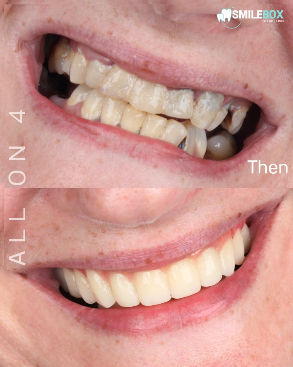 نتيجة قبل وبعد زراعة الأسنان All-on-4 في عيادة SmileBox Dental - فرع ثونجلور