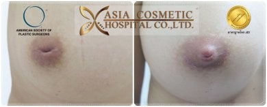 Результаты до и после уменьшения сосков в Asia Cosmetic Hospital, улучшенный вид соска