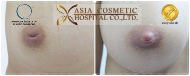 Результаты до и после уменьшения сосков в Asia Cosmetic Hospital, улучшенный вид соска