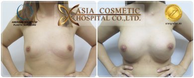 Before and after nipple reduction at Asia Cosmetic Hospital, visible improvement in nipple size