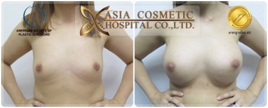 Before and after nipple reduction at Asia Cosmetic Hospital, visible improvement in nipple size