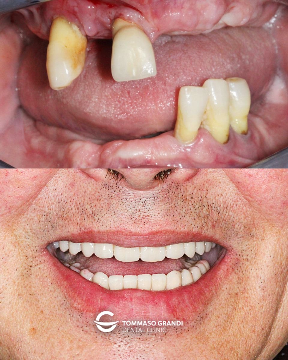 Результат до и после имплантации All-on-4 в Tommaso Grandi Dental Clinic, восстановленная улыбка