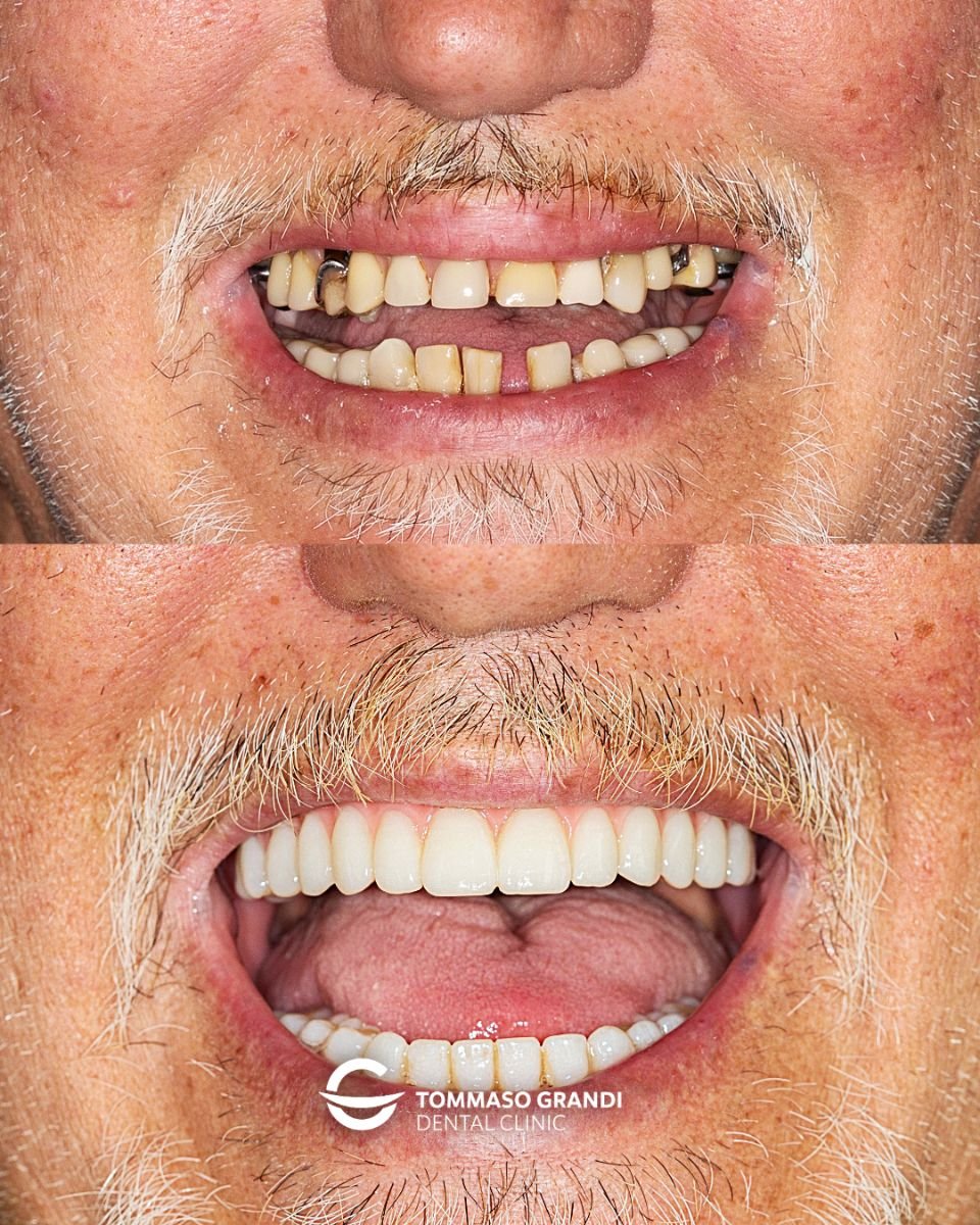 Результат до и после имплантации All-on-4 в Tommaso Grandi Dental Clinic, восстановленная улыбка