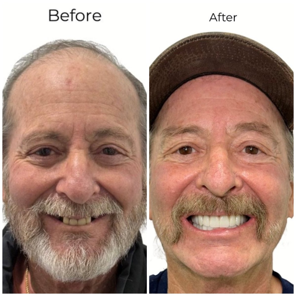 Resultados antes y después de implantes dentales en Varto Oral Surgery, sonrisa mejorada