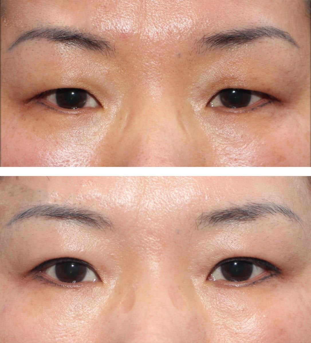 Resultados de blefaroplastia antes y después en HERSHE Plastic Surgery Korea, corrección de párpados