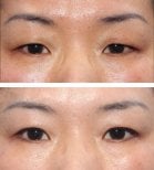 نتائج رأب الجفن قبل وبعد في HERSHE Plastic Surgery Korea، تصحيح الجفون