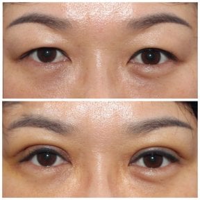 Результати блефаропластики до і після в HERSHE Plastic Surgery Korea, корекція повік