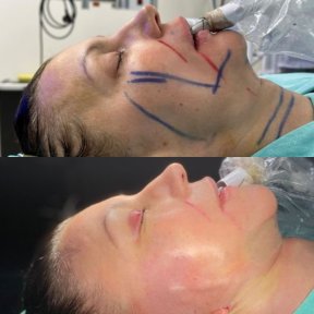 Vorher-nachher-Ergebnis Brauenlifting bei Dr. Safa Manav Clinic, sichtbare Verjüngung