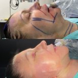 Vorher-nachher-Ergebnis Brauenlifting bei Dr. Safa Manav Clinic, sichtbare Verjüngung