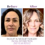 Facelift und Halslifting mit Fettinjektion bei Db'est Clinic, 2-Jahres-Ergebnis