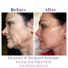 Vorher-nachher-Ergebnisse Facelift und Halsstraffung bei Db'est Clinic, Verbesserung durch Lipofilling
