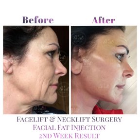 Facelift- und Halslifting-Ergebnis mit Fettinjektion bei Db'est Clinic, 2 Wochen