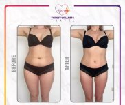 نتائج شفط الدهون قبل وبعد في عيادة TWT Health، تحسين واضح لتناسق الجسم