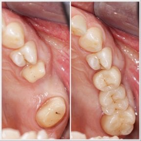 Before and after dental implant results at Smile Centrum, restored upper molar area