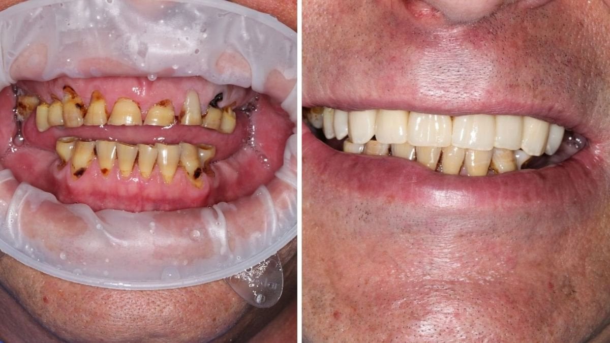 Результати до і після імплантації зубів у Smile Centrum – покращена усмішка та зуби