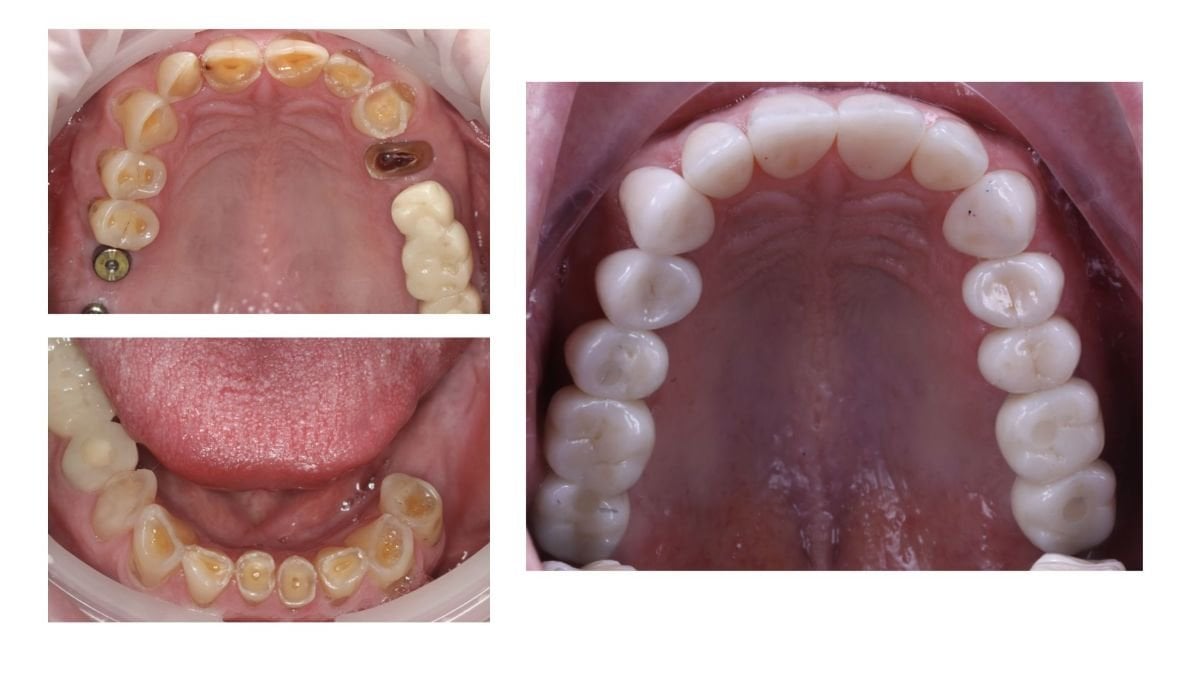 Результат до і після встановлення металокерамічних коронок на імплантах у Smile Centrum