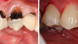 نتائج قبل وبعد تيجان معدنية خزفية مدعومة بزرع في عيادة Smile Centrum
