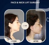 نتائج شد الوجه والرقبة قبل وبعد في TWT Health Clinic، تحسين تحديد الفك