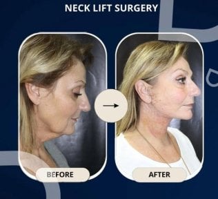 Before and after neck lift surgery results at TWT Health Clinic, visible jawline improvement
