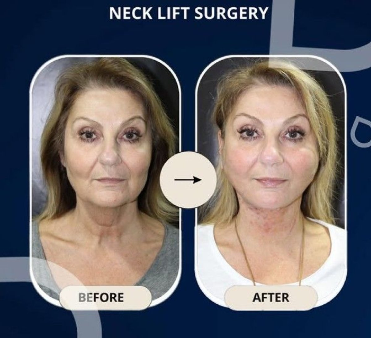 Resultados de lifting de cuello antes y después en TWT Health Clinic, cuello más firme