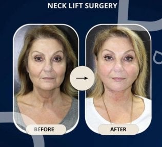 Before and after neck lift surgery results at TWT Health Clinic, visible neck tightening