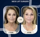 Before and after neck lift surgery results at TWT Health Clinic, visible neck tightening
