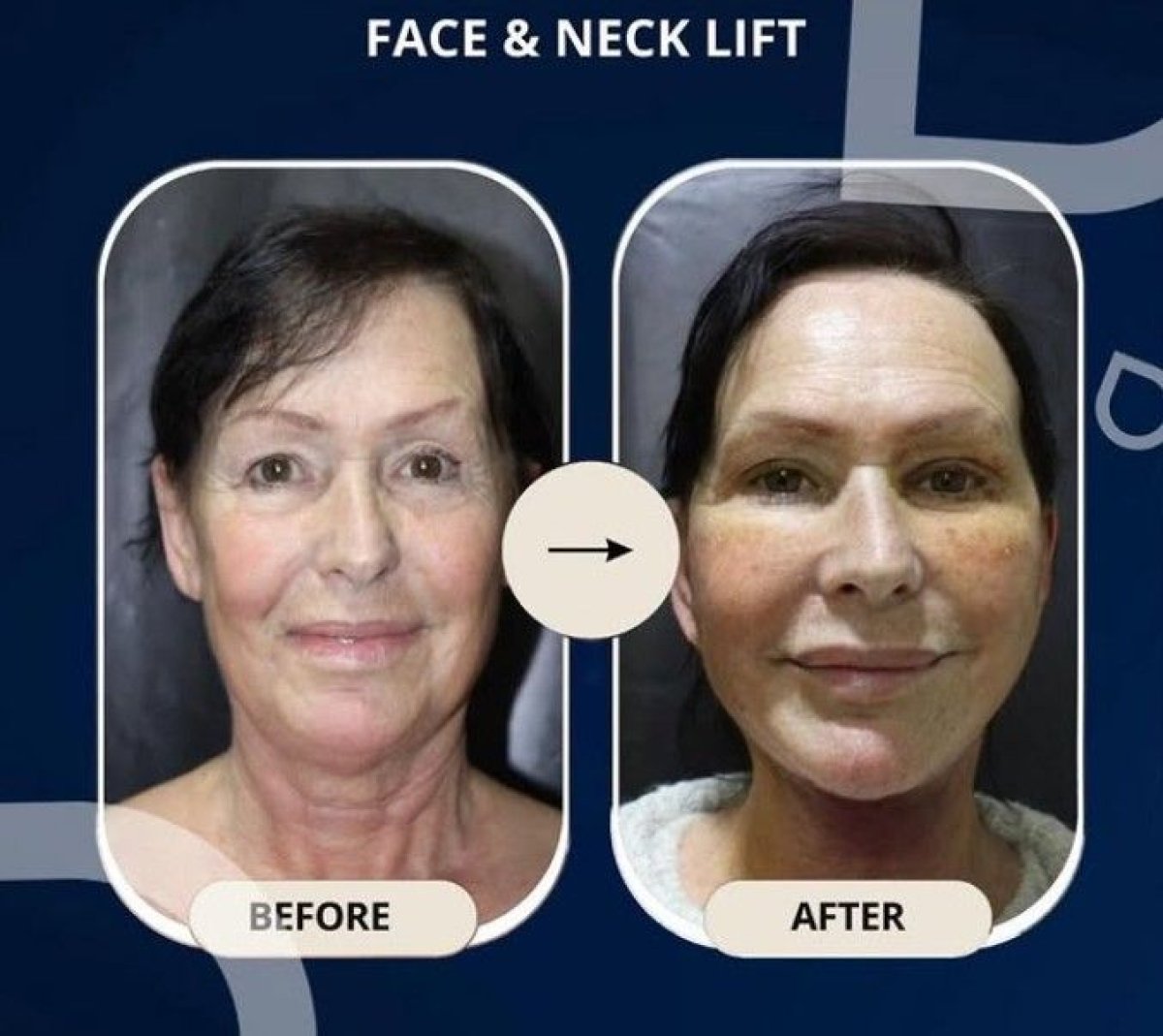 Resultados de lifting facial y de cuello antes y después en TWT Health Clinic, rejuvenecimiento