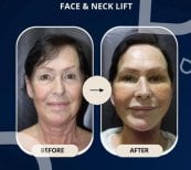 Before and after facelift and neck lift results at TWT Health Clinic, visible rejuvenation