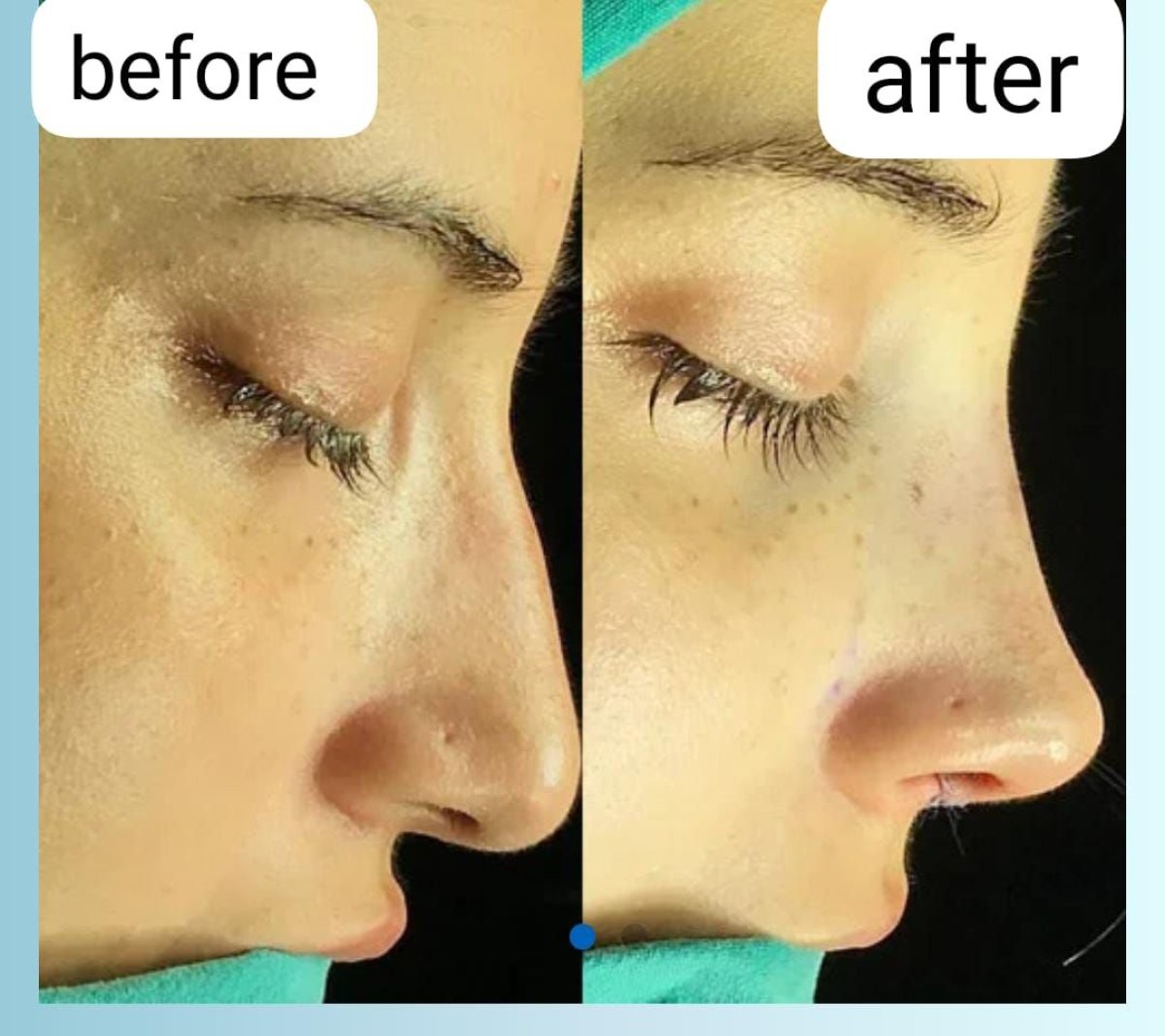 نتيجة قبل وبعد عملية تجميل الأنف التصحيحية في مستشفى ميموريال شيشلي، تحسين شكل الأنف