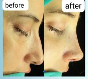 Before and after revision rhinoplasty result at Memorial Şişli Hospital, improved nose shape