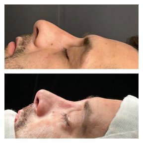 Before and after revision rhinoplasty results at Memorial Şişli Hospital, improved nose shape