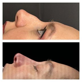 Before and after revision rhinoplasty results at Memorial Şişli Hospital, improved nose profile
