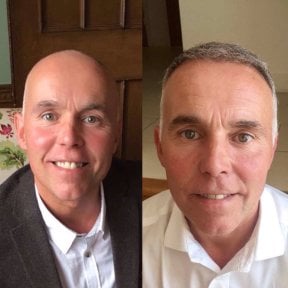 نتائج زراعة الشعر FUE قبل وبعد في مركز إسطنبول لجراحة التجميل