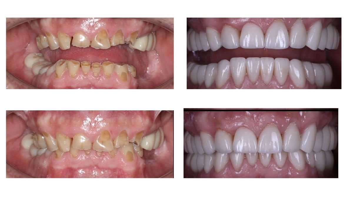 نتائج قبل وبعد الفينير في Smile Centrum – تحول الابتسامة بمظهر طبيعي