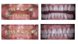 До та після встановлення вінірами в Smile Centrum – перетворення посмішки з природним результатом